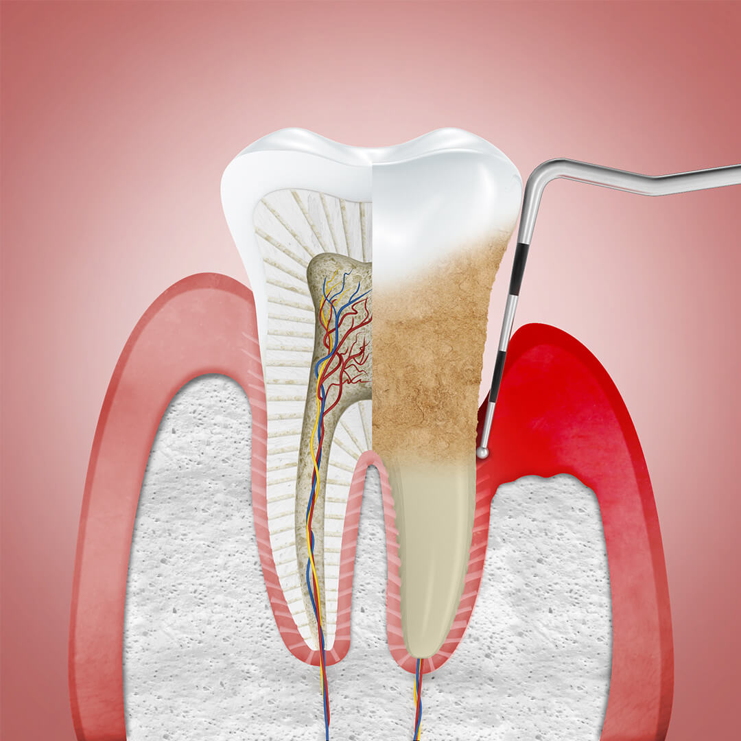 What Is Periodontitis Parodontax